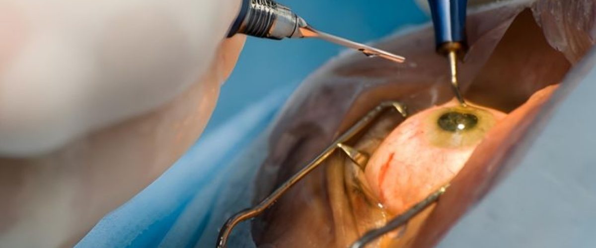 cirurgia de catarata